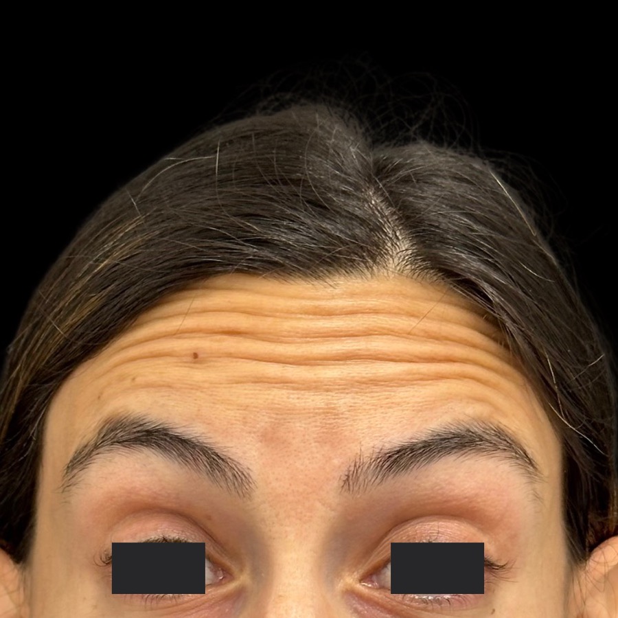 Antes