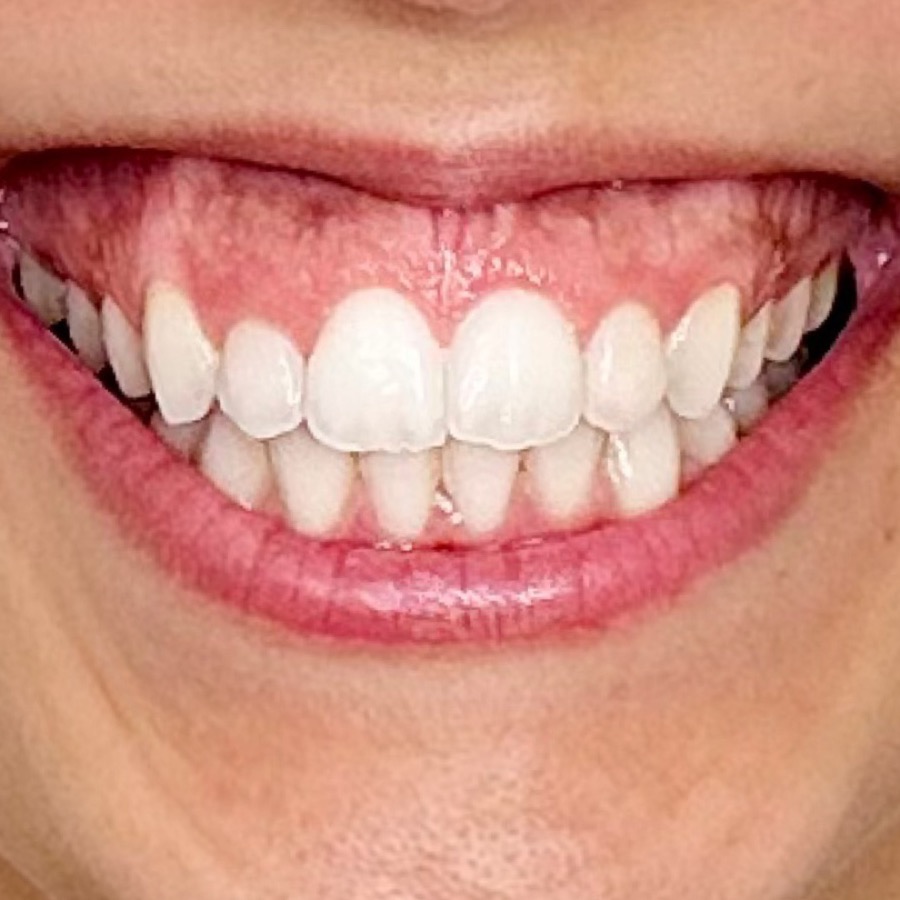 Antes