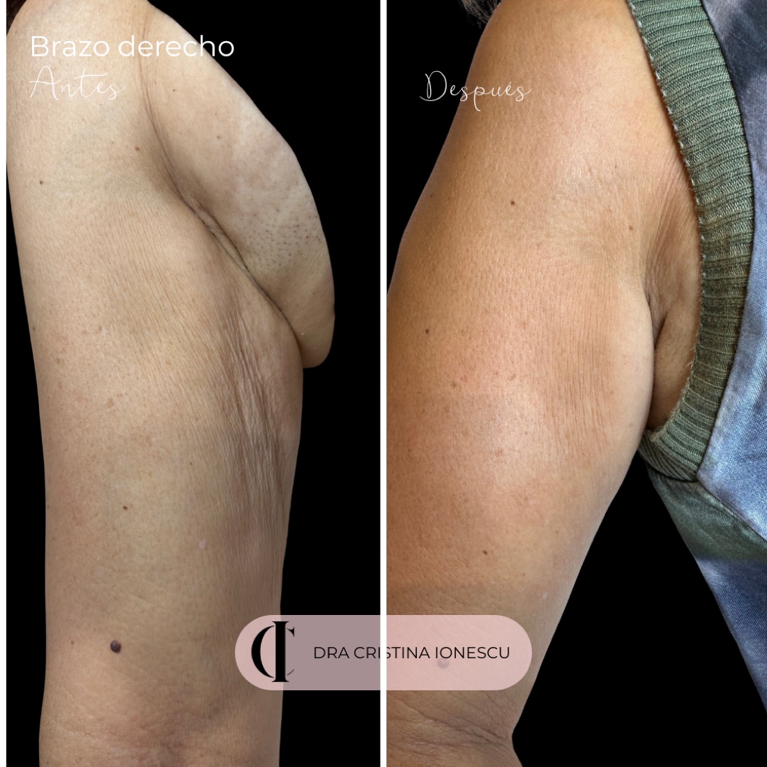 Antes y después de tratamiento de flacidez corporal en brazo