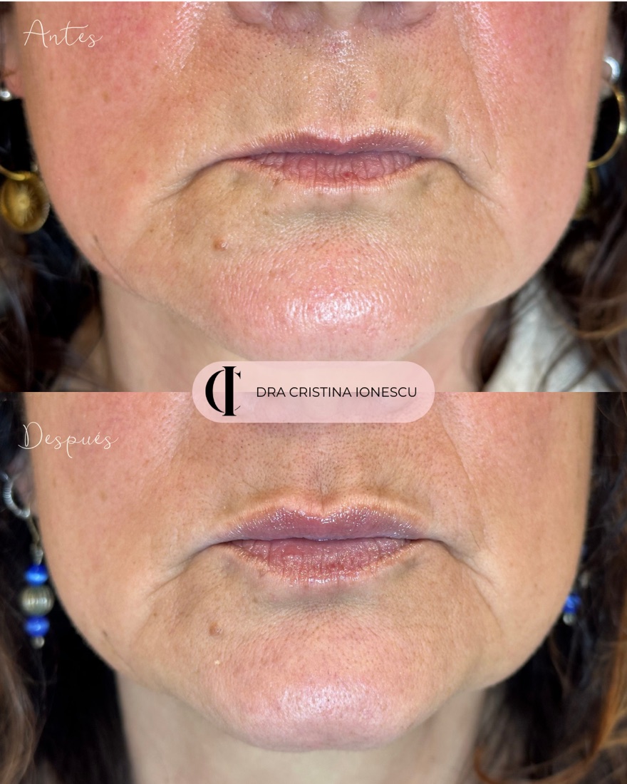 Antes y después de aumento de labios