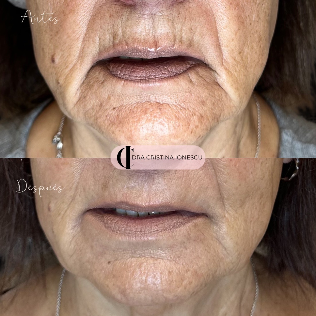 Antes y después de reposicionamiento peribucal