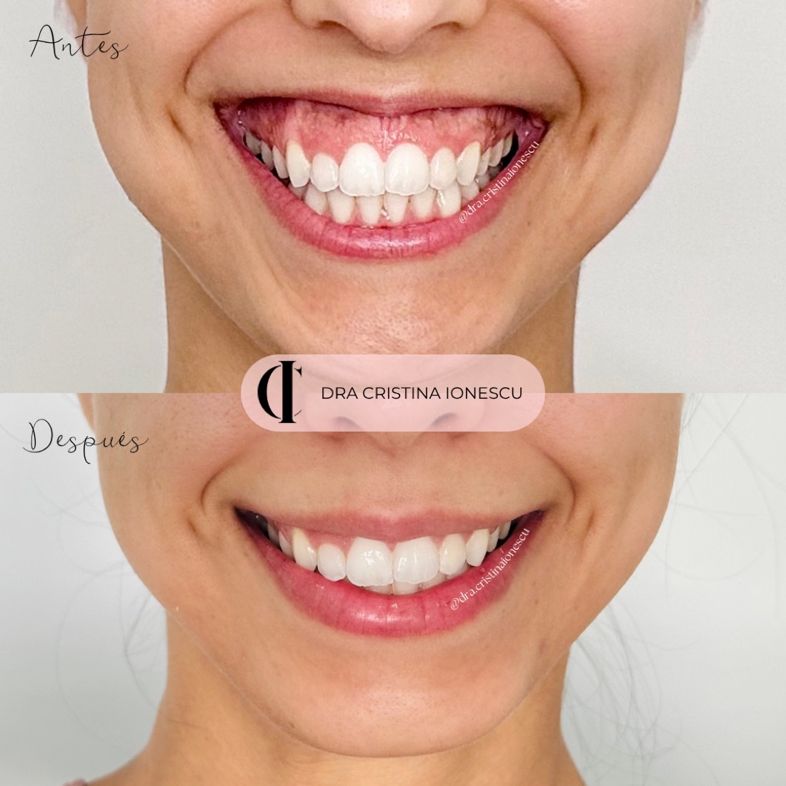Antes y después de sonrisa gingival con bótox